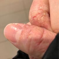 手荒れが治らないです 4年間ほどひどい手荒れに悩まされていま Yahoo 知恵袋