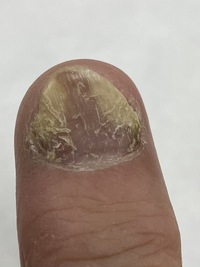 爪について爪が変形してきました この指だけです 皮膚科では生え変わ Yahoo 知恵袋