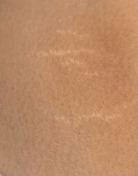 この白い線みたいなやつ何だか分かりますか 膝と内ももにあります Yahoo 知恵袋