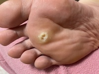 これは魚の目ですか グロ注意 早く病院へ行かなければいけないと分 Yahoo 知恵袋