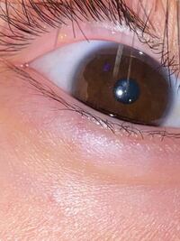 目の瞼にできものができたのですが 病院休みで行けません これっても Yahoo 知恵袋