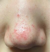 毛穴にずっと白い角栓が詰まってます 洗顔などしても取れる気配が1つもあ Yahoo 知恵袋