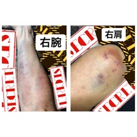 亀頭包皮炎について教えてください 細菌性 真菌性どちらなのかは分かっ Yahoo 知恵袋