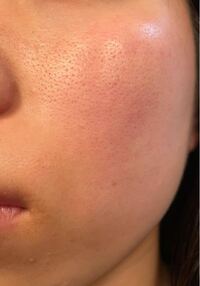 顔の毛穴をなくす方法教えてください 毛穴の悩み 何をど Yahoo 知恵袋