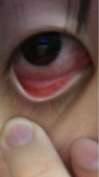 黒目の下がとても赤くて瞬きすると痛いです ずっとコンタクトが Yahoo 知恵袋