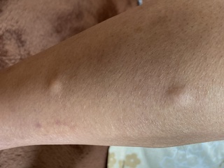 男子高校生2年生です 家庭用脱毛のケノンを使ったら写真のようなぷっくりしたも Yahoo 知恵袋