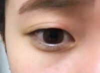 瞼が伸びて腫れて ます 赤くなってて少しヒリヒリします アイプ Yahoo 知恵袋