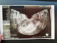 胎嚢の形について 現在推定5w1dです 先程胎嚢確認のためにエ Yahoo 知恵袋