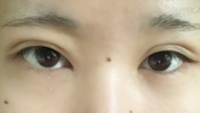 埋没をして１年になるんですが、線の上にお肉が乗ってしまっていて不自然です。
これって詐術失敗ですか？ 
