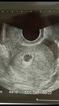 胎芽が見えなくて不安です 5週3日胎嚢のみ確認できました まだから Yahoo 知恵袋
