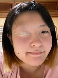 瞼のいじりすぎで瞼が伸びてしまいました もう二重にすることはできないのでしょう Yahoo 知恵袋