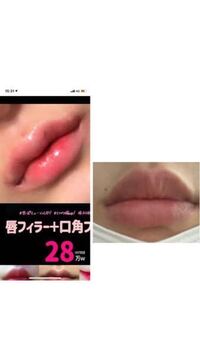 口角あげたいのですが口角ボトックスやられた方感想聞きたいです Yahoo 知恵袋