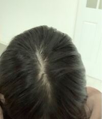 中学3年生の女子です このような感じでつむじがだんだん薄くなっています Yahoo 知恵袋