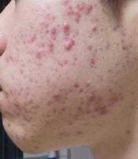 マスクでニキビが増えて困ってます 18歳の男です 去年の冬頃 Yahoo 知恵袋