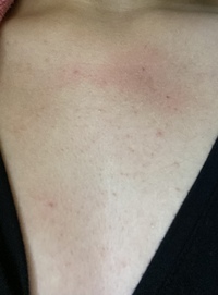 観覧注意 胸のニキビが特に酷くて 夏より冬の方が凄くなってきて Yahoo 知恵袋