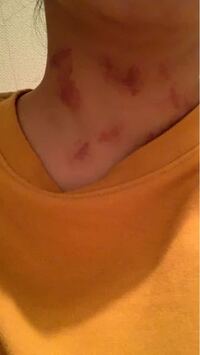 キスマークの付け方を教えてください 先日 彼女と抱き合ってい Yahoo 知恵袋