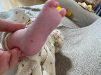 生後1ヶ月の赤ちゃんの足裏に 赤い内出血のようなものを見つけま Yahoo 知恵袋