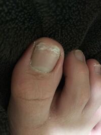 お見苦しい写真もすみません 私の足の親指の爪がこのように模様 Yahoo 知恵袋
