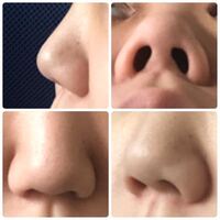 赤ちゃんの色白 色黒 どうして赤ちゃんの手は他の部分より白いので Yahoo 知恵袋