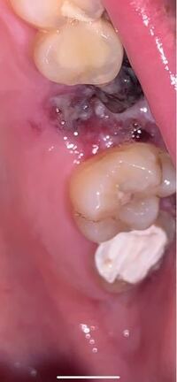 昨日上の歯の虫歯を抜歯したんですがこれはドライソケットでしょうか Yahoo 知恵袋