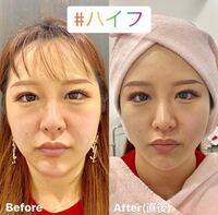 ハイフはあまりしない方がいい やり過ぎたら逆にたるみやすくなる Yahoo 知恵袋