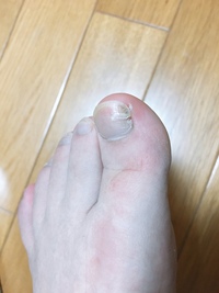 足の親指の爪が深めの位置で横に割れてる感じです 手の親指もここまででは無いで Yahoo 知恵袋
