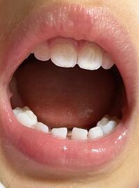 乳歯ですが 前歯が少し茶色 がかり マダラになっています これ Yahoo 知恵袋