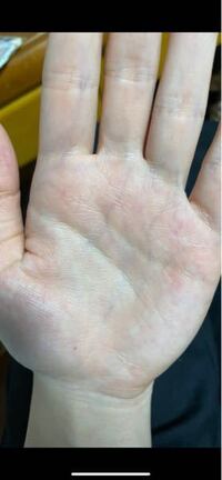 手のひらも指先も血管が透けていて気持ち悪いです 皮膚が薄いのかわか Yahoo 知恵袋