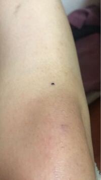 4日ほど前に膝を見たら濃い黒色のほくろができていました 多分いきなりできまし Yahoo 知恵袋