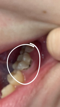 歯と歯茎の間 が欠けて黒いのがありますこれは虫歯ですか 写真汚くて Yahoo 知恵袋
