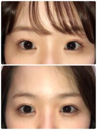 1週間前に目頭切開をしたのですがあまり変わってないように見えます カウンセリ Yahoo 知恵袋