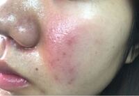 こんな感じですぐ頬が赤くなって汚いです Tt どうすれば治りますか Yahoo 知恵袋