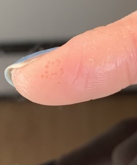 私はアトピーで手荒れがひどく 薬を塗って治りました ですが昨日くらいからプツ Yahoo 知恵袋