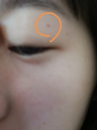 起きたら目の上に赤い点がありました 痛みやかゆみなどはありません Yahoo 知恵袋