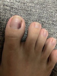 足の親指爪が黒くなっています これは右足で内出血 している感じです 左足の親 Yahoo 知恵袋