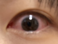目の充血についてです寒かったので目が乾燥するなくらいに思って塾に行 Yahoo 知恵袋