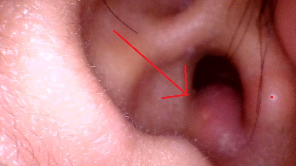 耳の腫れについて2日前から右耳が腫れています 添付画像あり 腫れている Yahoo 知恵袋