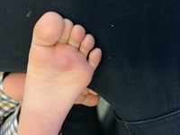 2歳の息子の足の裏に魚の目のような腫れがありますが なんでしょう 行くとした Yahoo 知恵袋