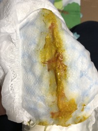 うんち漏れ写真あり 新米ママです 生後4ヶ月の子供がいます 最近うんちをする Yahoo 知恵袋