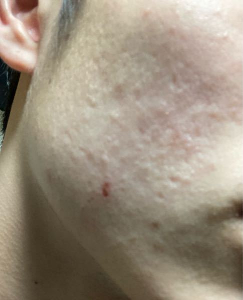 汚い写真で申し訳ないですが これってクレーター肌っていうやつですか 凹んでる Yahoo 知恵袋