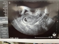 このエコー写真で胎嚢の大きさはわかりますか 今朝 産婦人科で妊娠の確認をし Yahoo 知恵袋