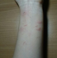 (画像有り)私はストレスが溜まると爪を立ててしまう癖があります。爪を立てた後の、ヒリヒリとした痛さが好きで辞められません。 画像を見てもらえると分かるように、浅い傷なのでまあいいかと思っていました。
ですが、友人などに見られた時が心配です。皆さんなら友達の腕が画像のような腕だった時気にしますか？答えていただけると嬉しいです。