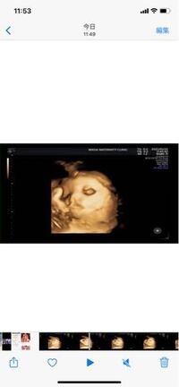 34週の妊婦検診のエコー写真がこんな感じでした パッと見口唇裂にみ Yahoo 知恵袋