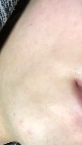 フェイスラインとか顎の肌荒れ みたいなのってどうやってなおしますか ニキビと Yahoo 知恵袋