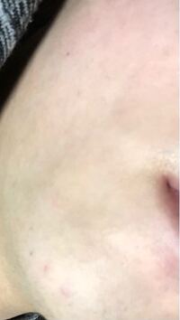 フェイスラインとか顎の肌荒れ みたいなのってどうやってなおしますか ニキビと Yahoo 知恵袋