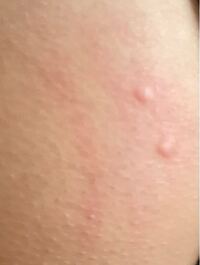 お尻の皮膚にこのようなものができてしまって痒いんですが なんでしょ Yahoo 知恵袋