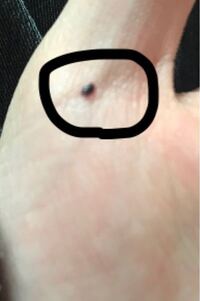 朝起きたらこのホクロの様な点が親指についていました これは血豆とか Yahoo 知恵袋