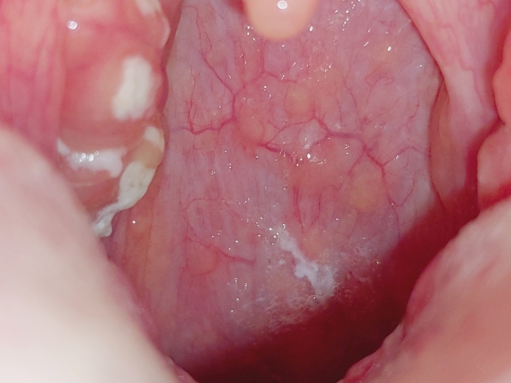 慢性扁桃炎 慢性扁桃腺炎 で月に約2回は再発 してます ほぼ毎日腫れています Yahoo 知恵袋