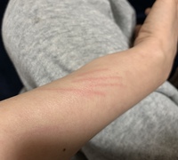 体に出来る身に覚えのない引っ掻き傷のような鋭利な傷について Yahoo 知恵袋