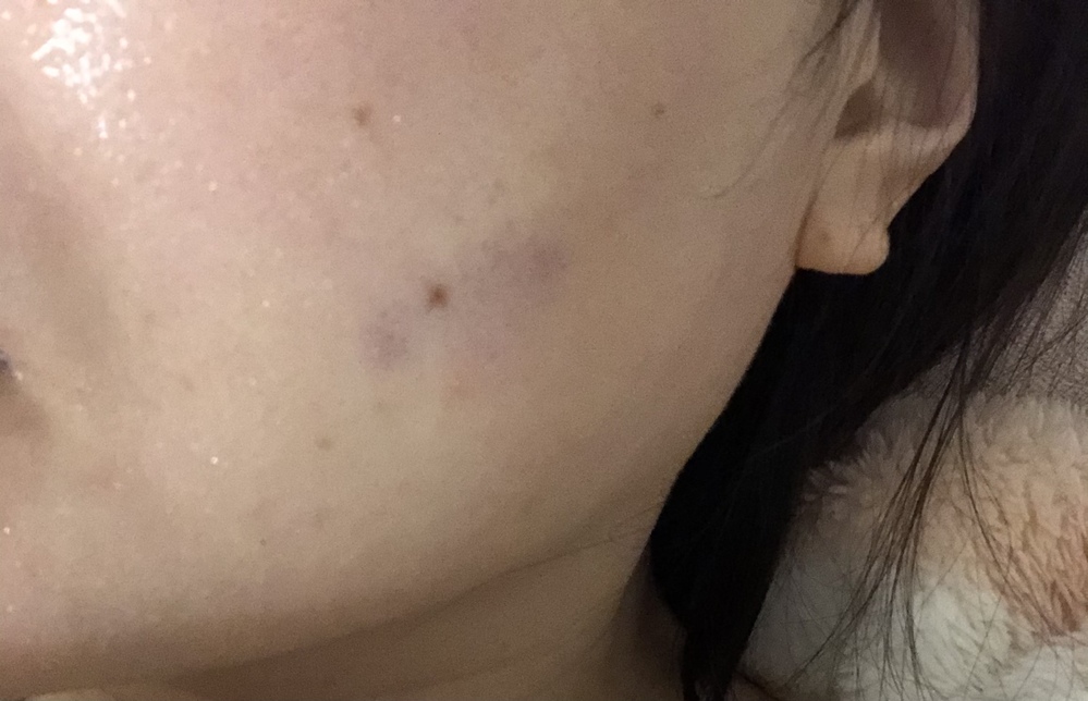 顔のシミ について頬の少し下にシミ があります薄い紫でアザのような色です Yahoo 知恵袋